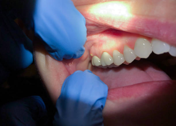 Best Emergency Wisdom Teeth Removal in Black Mountain, NC