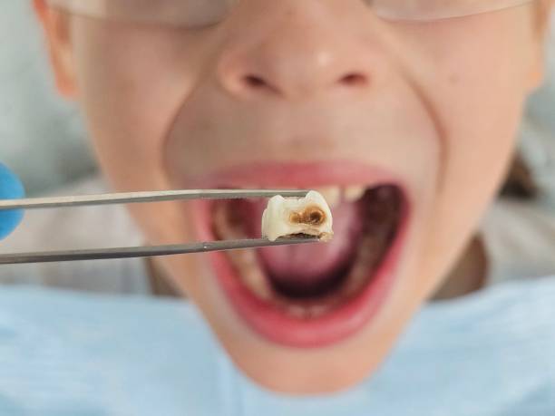 Best Emergency Dental Care for Broken or Chipped Teeth in Black Mountain, NC